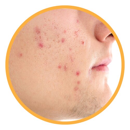 Acne-Removal-treatment