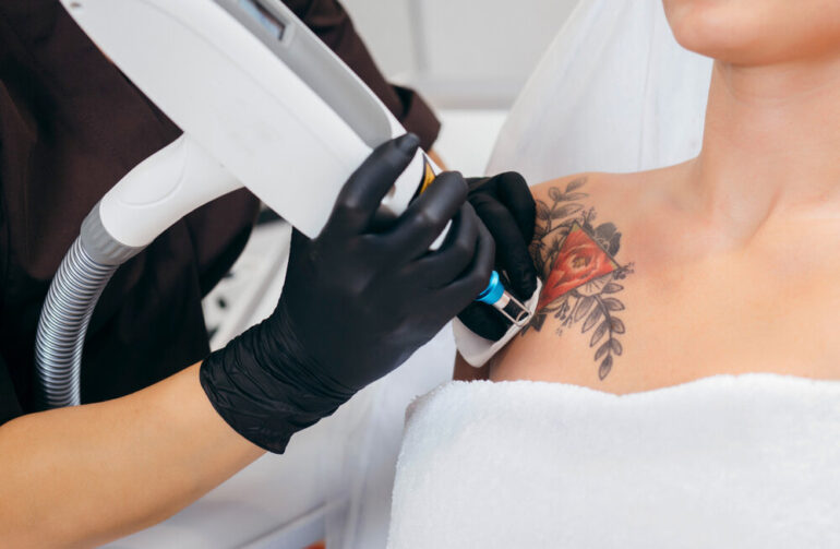 tattoo-removal-in-Jaipur