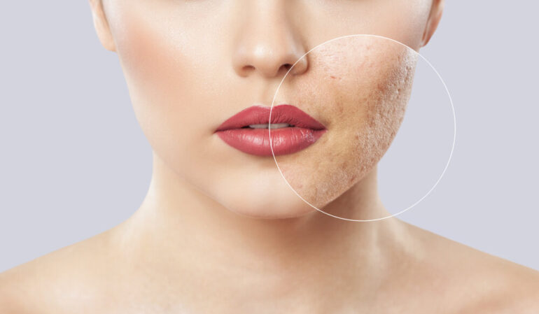Best Acne Scars Treatments in Jaipur